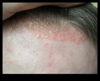 Vitamīni izmantojot zemu ogļhidrātu saturu iekaisīgām ādas slimībām